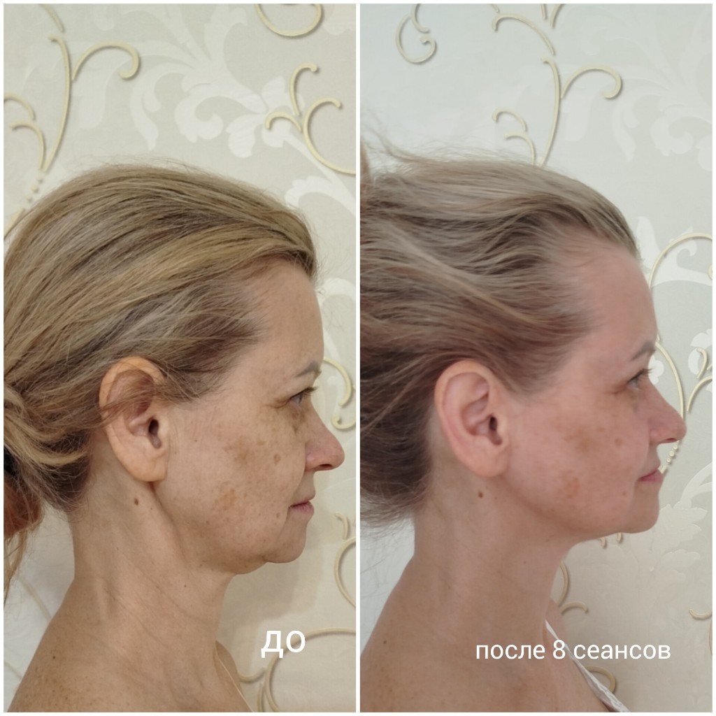 Профиль до и после 8 сеансов